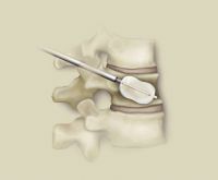 Kyphoplastie 08 - Therapie-operativ