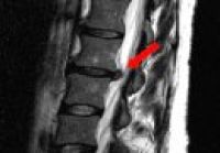 Endoskopische Operationen 08 - Therapie-operativ